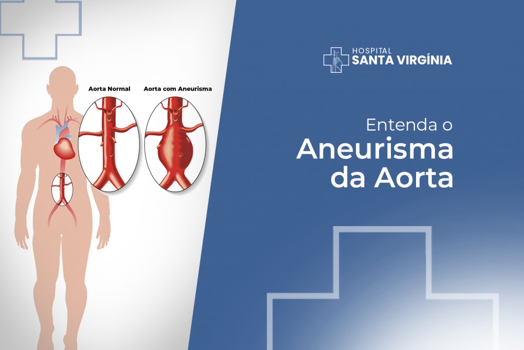 Entendendo o Aneurisma da Aorta: Prevenção, Diagnóstico e Tratamento ...