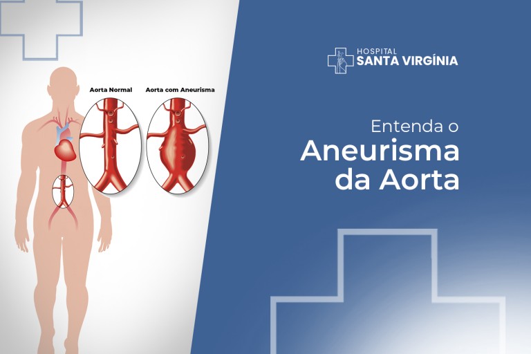 Entendendo o Aneurisma da Aorta: Prevenção, Diagnóstico e Tratamento ...